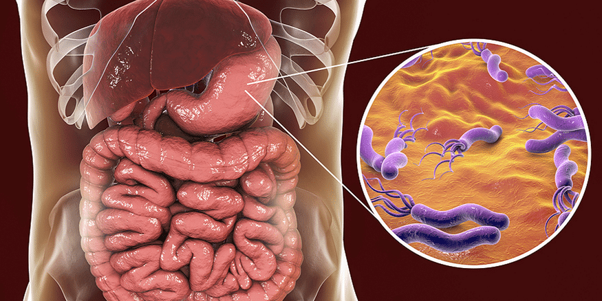A Natural H Pylori Remedy Without Using Antibiotics