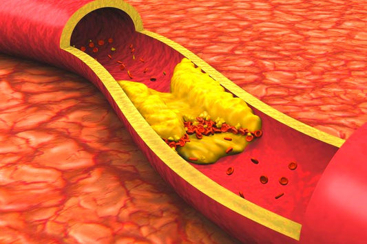 Wie man den Cholesterinspiegel auf natürliche Weise senkt