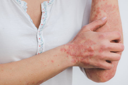 woman with psoriasis on arm